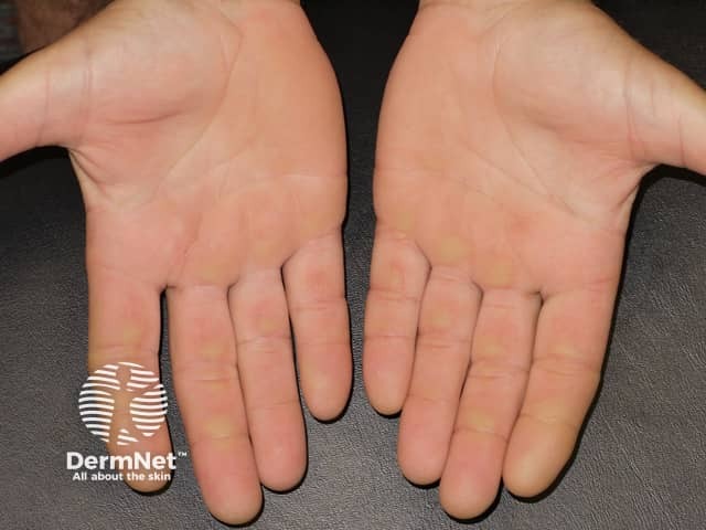 Painful red, callused palms due to protein kinase inhibitor