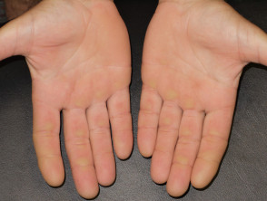 Painful red, callused palms due to protein kinase inhibitor