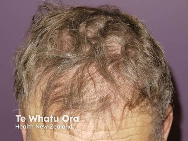 Alopecia due to vemurafenib
