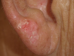 Sunburned earlobe following minimal sun exposure due to vemurafenib