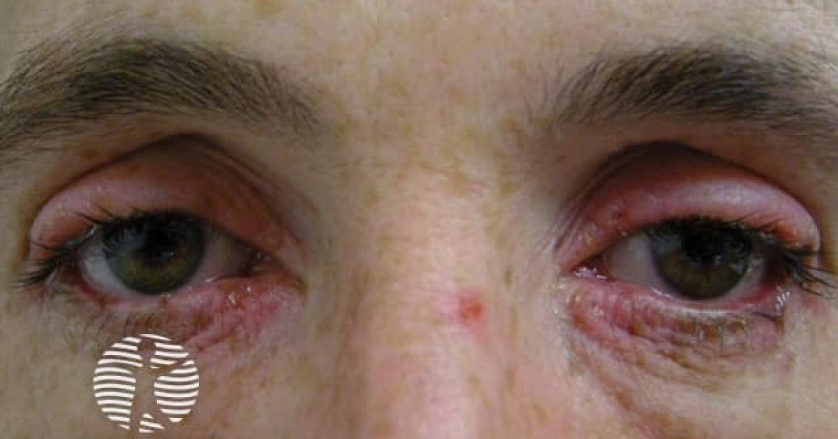 Eye involvement in erythema multiforme image