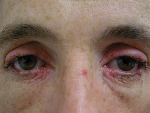 Eye involvement in erythema multiforme