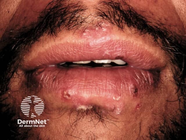 Herpes simplex labialis associated with erythema multiforme