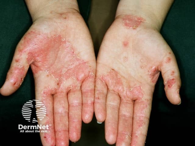 Nonspecific hand dermatitis