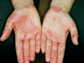 Hand dermatitis in a farmer