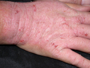 Hand dermatitis due to rubber allergy