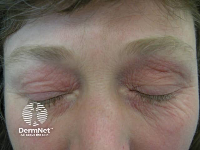 Eyelid dermatitis due to airborne compositae allergy