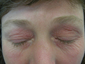 Hand dermatitis due to compositae allergy