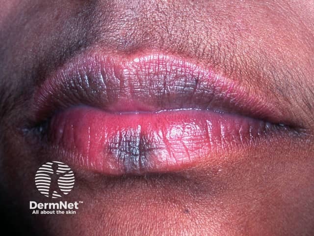 Hyperpigmentation on the lip after resolution of an acute fixed drug eruption