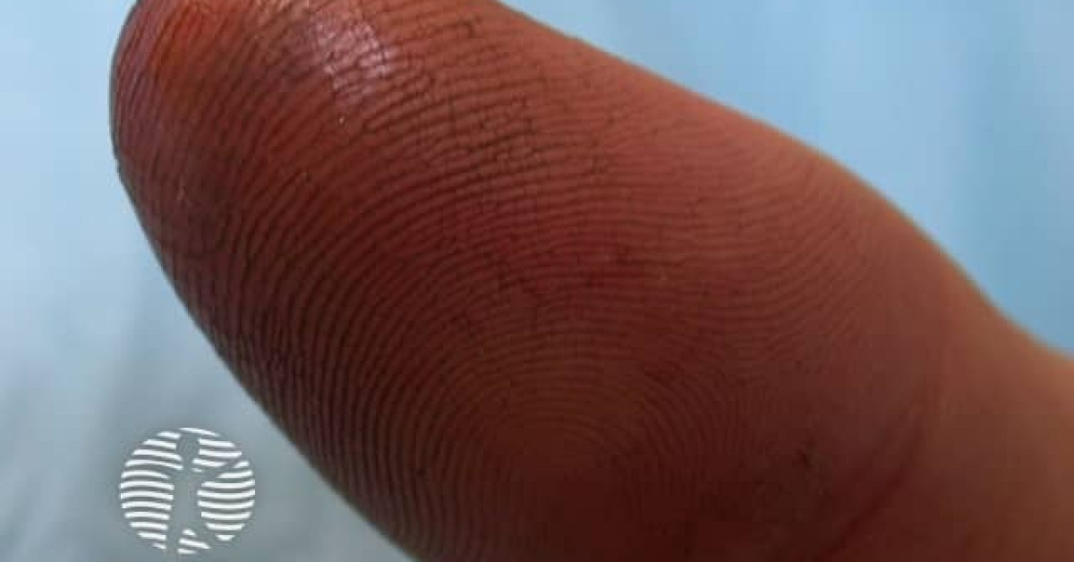 Fluoride burns image