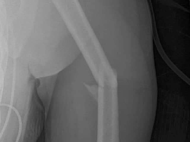 Fracture of humerus