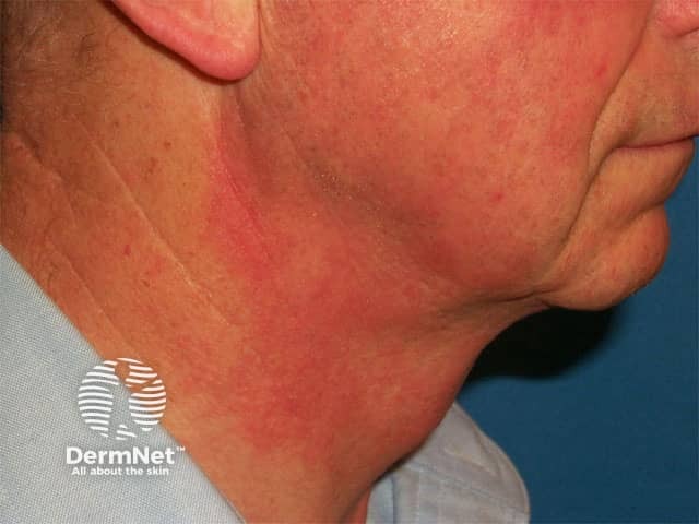 Photoallergic contact dermatitis due to a fragrance in an aftershave