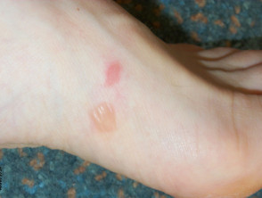 Friction blisters