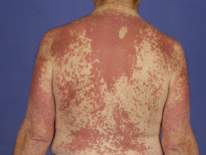 Interstitial granulomatous dermatitis