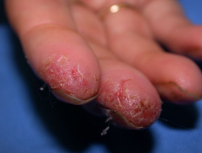 Hand dermatitis in hairdresser