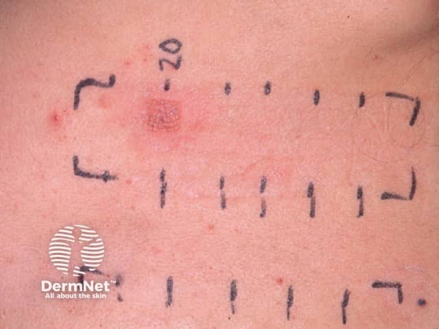Positive patch test to PPD
