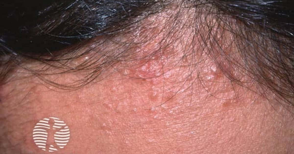 Hair dye reaction image