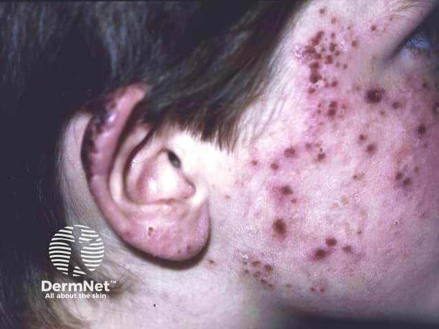 Hydroa Vacciniforme Hydroa Vacciniforme