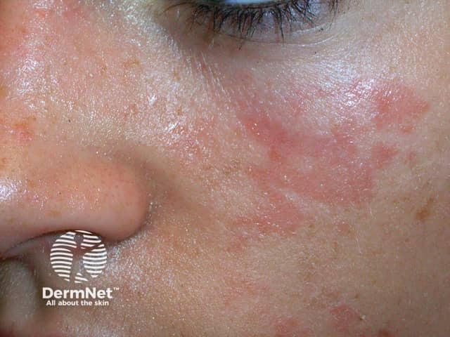 Rash caused by acne cleanser