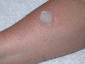 Cold urticaria ice cube test