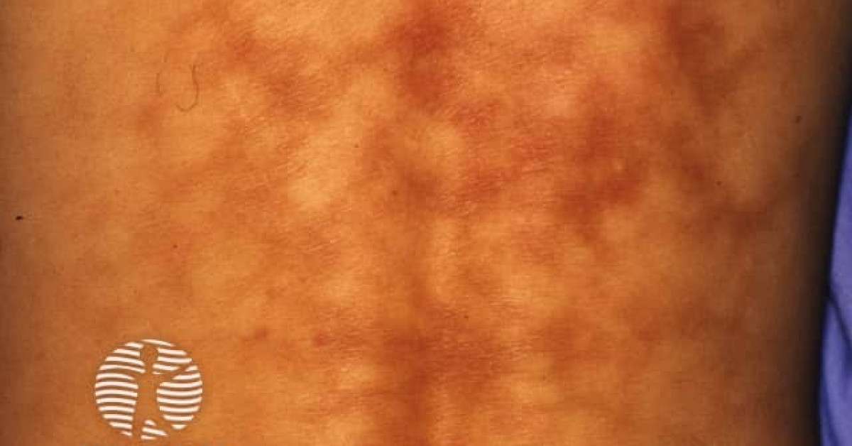 Erythema ab igne image