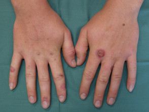 Occupational hand infection