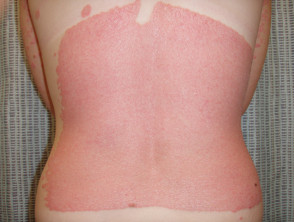 Koebner phenomenon in psoriasis due to sunburn