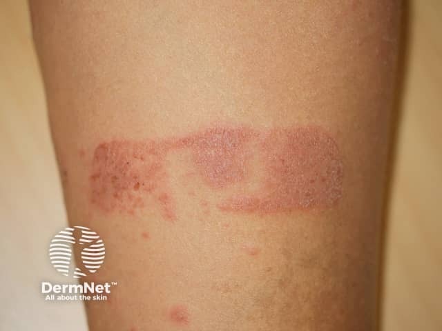 Contact dermatitis to adhesive plaster