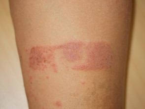 Koebner phenomenon in psoriasis due to contact dermatitis to adhesive plaster