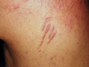 70 Pacemaker Scar Stock Photos Pictures  RoyaltyFree Images  iStock
