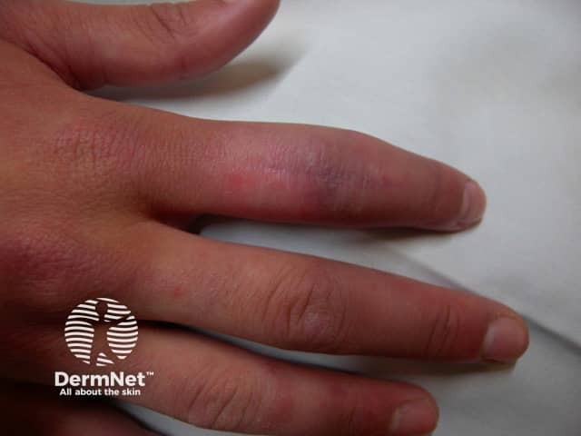 Persistent swelling middle phalanx index finger