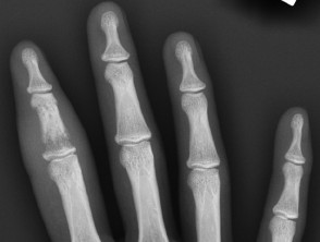 Microgeodic disease on X-ray