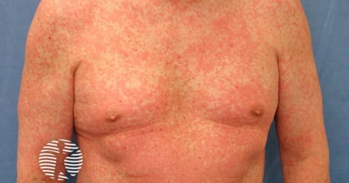 Morbiliform Rash Appearance Morbilliform drug eruption image