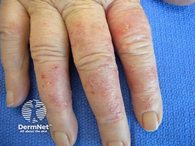 Occupational hand dermatitis