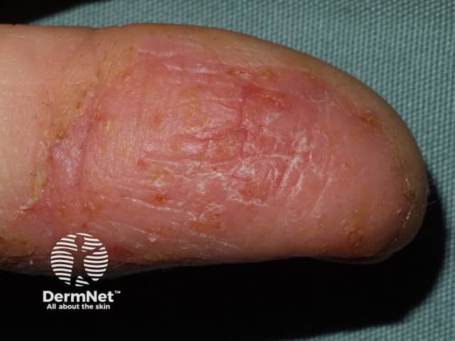 Occupational hand dermatitis on fingertip