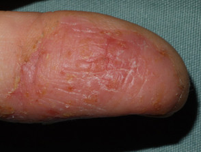 Occupational hand dermatitis