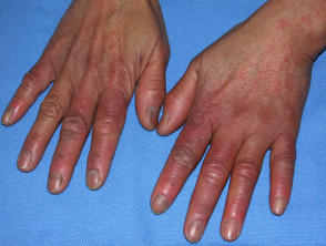 lupus pernio hands