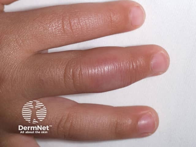 Swollen finger originally diagnosed as chilblains