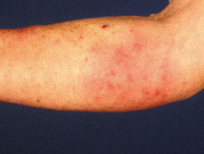 Neutrophilic dermatosis associated with rheumatoid arthritis