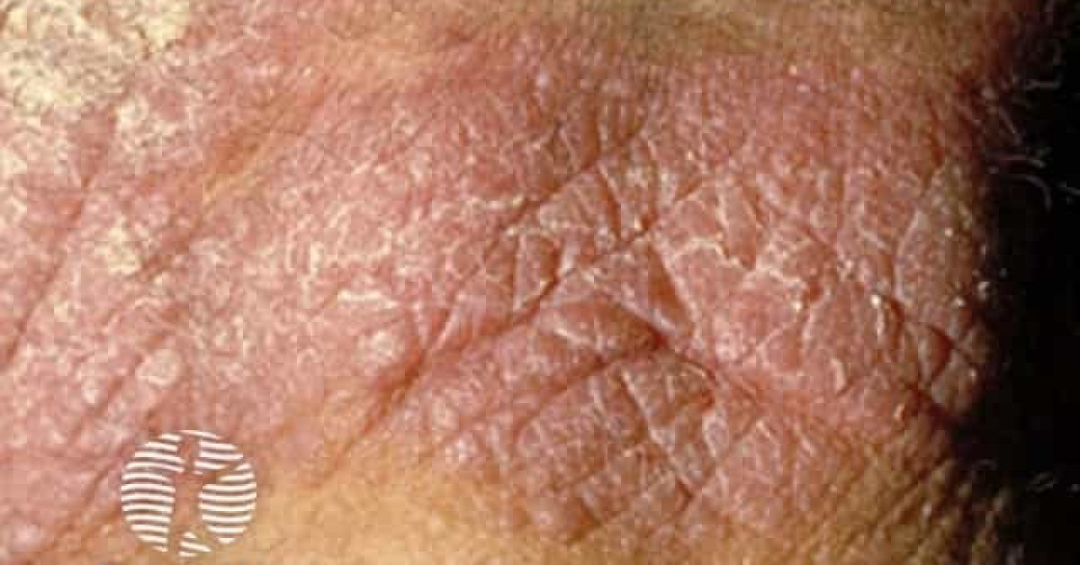 Chronic actinic dermatitis image