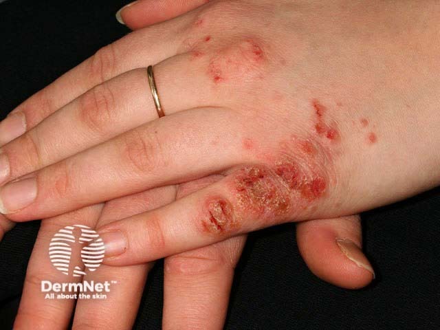 Infected hand dermatitis