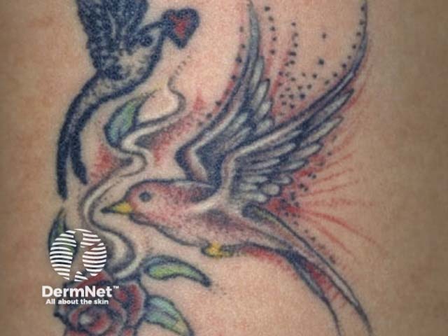 Lichenoid reaction to red tattoo pigment