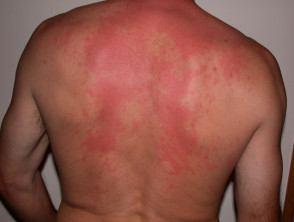 Scombroid rash