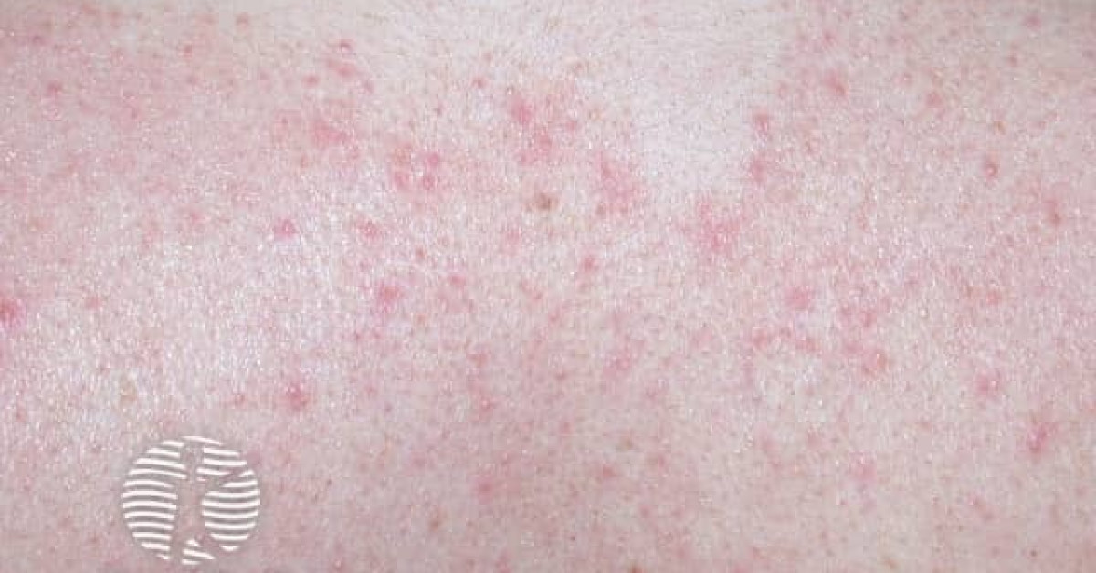 Seborrhoeic dermatitis image