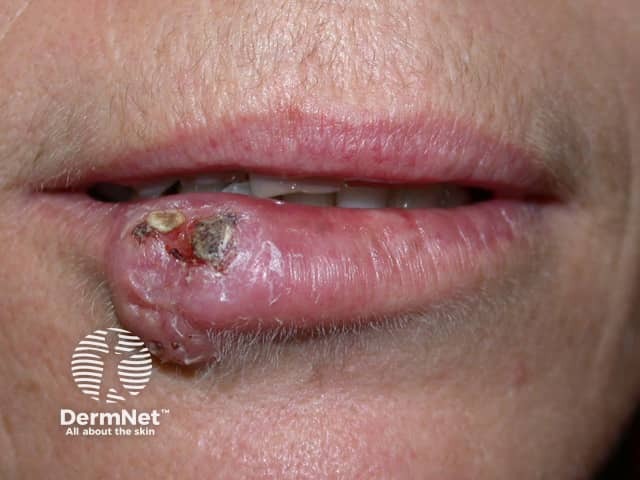 Lip cancer (squamous cell carcinoma)