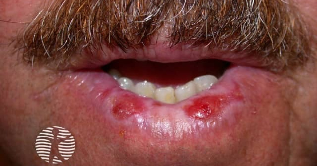 Smoking and cheilitis image