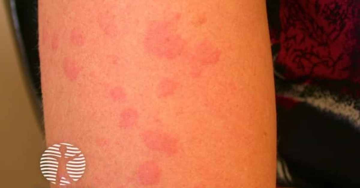 Solar Urticaria Image