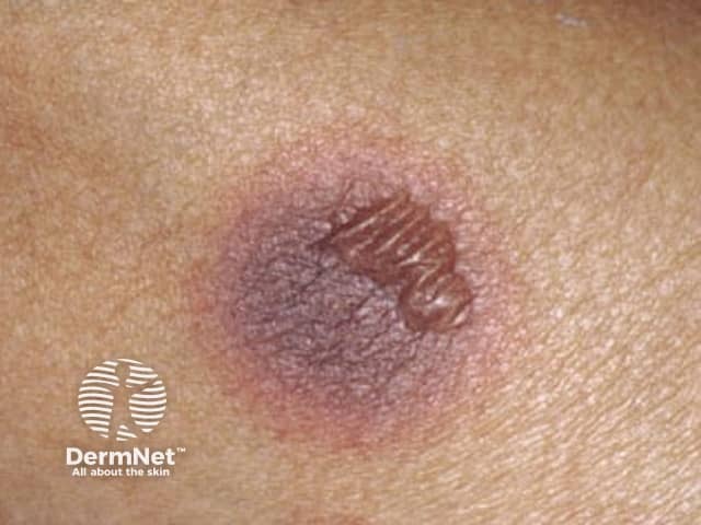 Targetoid lesion in fixed drug eruption