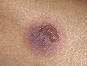 Targetoid lesion in fixed drug eruption