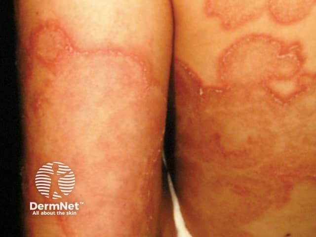 Targetoid lesion in erythema annulare centrifugum